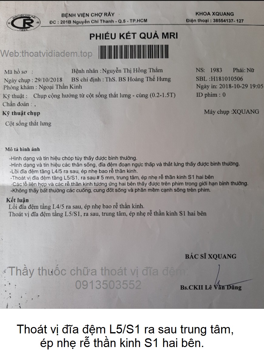 Thoát vị đĩa đệm L5/S1